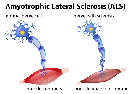 Concepto de esclerosis lateral amiotrófica
