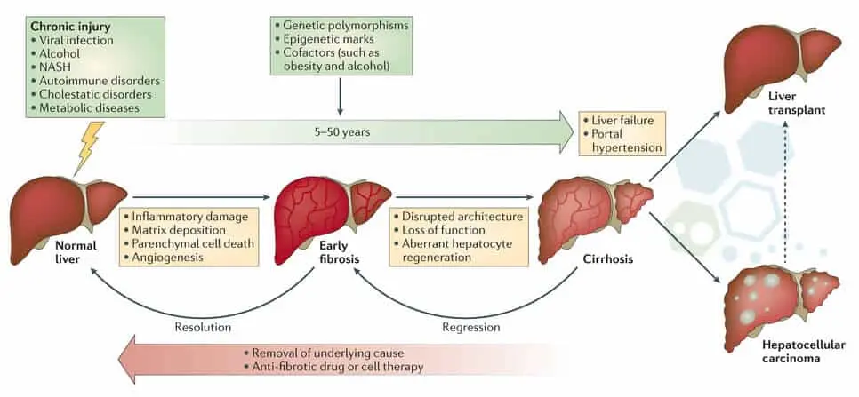 Un gráfico que muestra el progreso de los pacientes antes y después del tratamiento con células madre para las enfermedades hepáticas