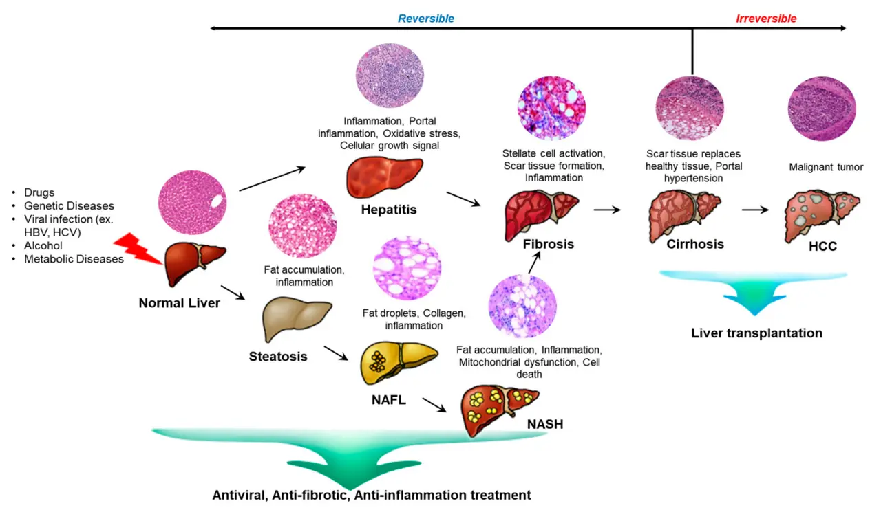 Una infografía que ilustra cómo funciona el tratamiento con células madre en las enfermedades hepáticas