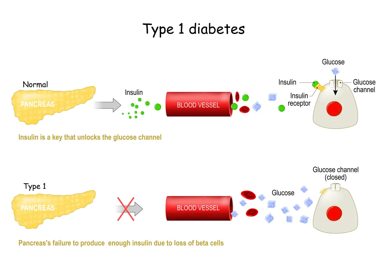 Tipos de diabetes mellitus.