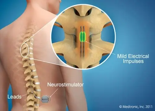 Estimulación Epidural
