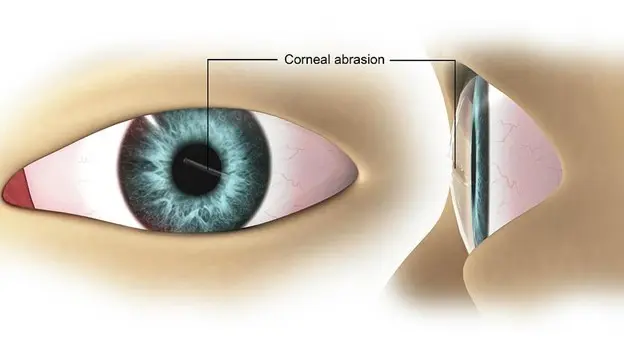 Daño corneal
