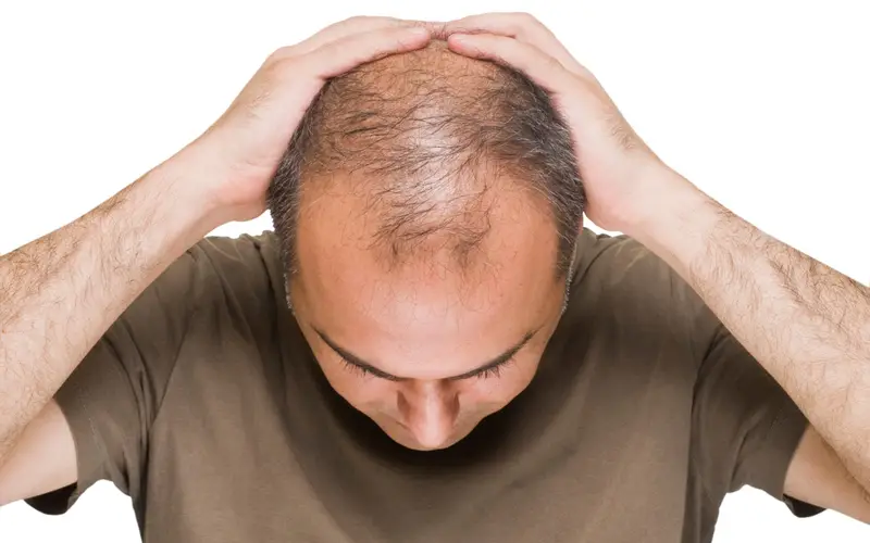El potencial de la terapia con células madre para la caída del cabello