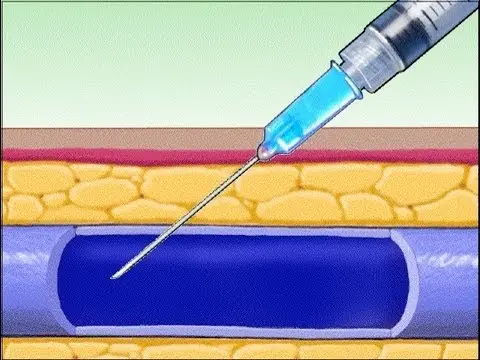 Inyección intravenosa