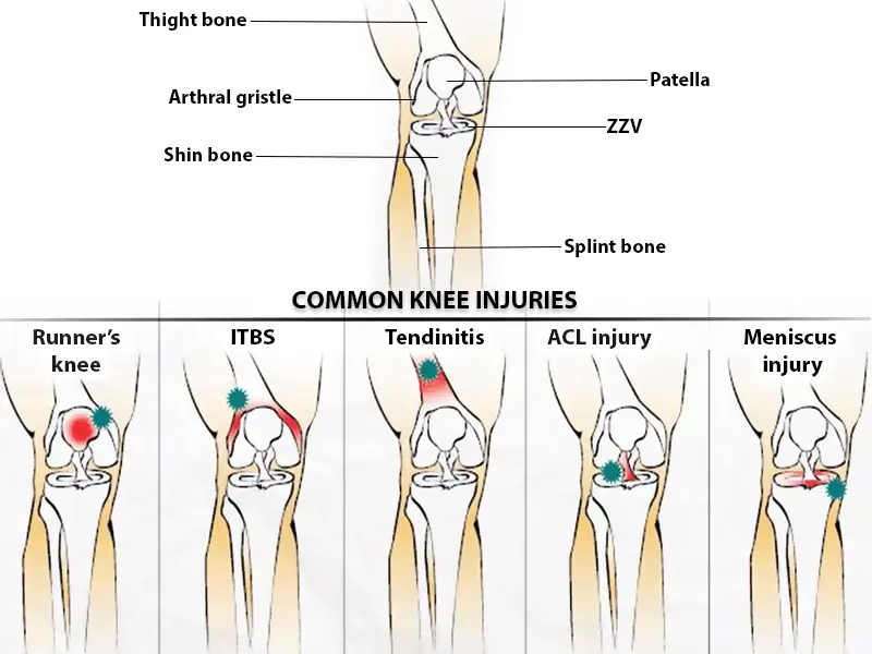 Tipos comunes de lesiones de rodilla