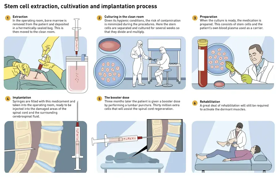 proceso del tratamiento con células madre de una lesión de rodilla